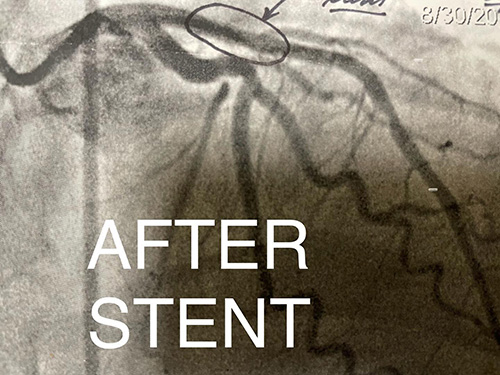 HeartCare4life, Dr. Vimal Nanavati, Board Certified in Cardiology and Interventional Cardiology LAD Lesion - After