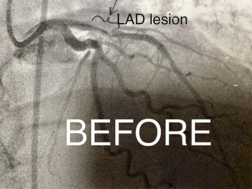 HeartCare4life, Dr. Vimal Nanavati, Board Certified in Cardiology and Interventional Cardiology LAD Lesion - Before