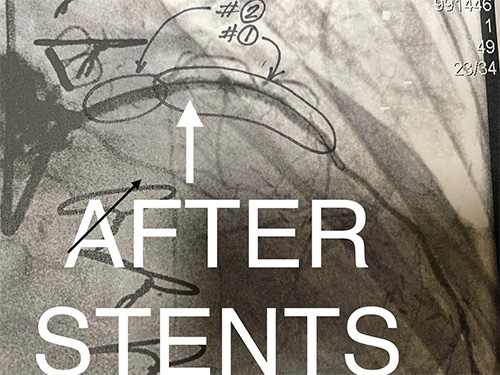 HeartCare4life, Dr. Vimal Nanavati, Board Certified in Cardiology and Interventional Cardiology LAD Stenosis - After