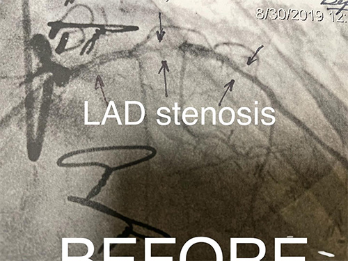 HeartCare4life, Dr. Vimal Nanavati, Board Certified in Cardiology and Interventional Cardiology LAD Stenosis - Before