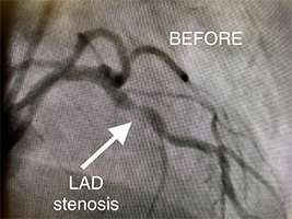 HeartCare4life, Dr. Vimal Nanavati, Board Certified in Cardiology and Interventional Cardiology Lad Stenosis - Before