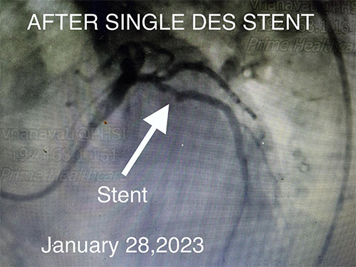 HeartCare4life, Dr. Vimal Nanavati, Board Certified in Cardiology and Interventional Cardiology LCX Lesion - After