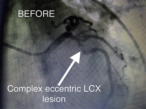 HeartCare4life, Dr. Vimal Nanavati, Board Certified in Cardiology and Interventional LCX Lesion - Before