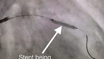 HeartCare4life, Dr. Vimal Nanavati, Board Certified in Cardiology and Interventional Cardiology Left Anterior - After1