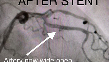 HeartCare4life, Dr. Vimal Nanavati, Board Certified in Cardiology and Interventional Cardiology Left Anterior - After2