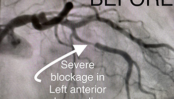 HeartCare4life, Dr. Vimal Nanavati, Board Certified in Cardiology and Interventional Cardiology left Anterior - Before