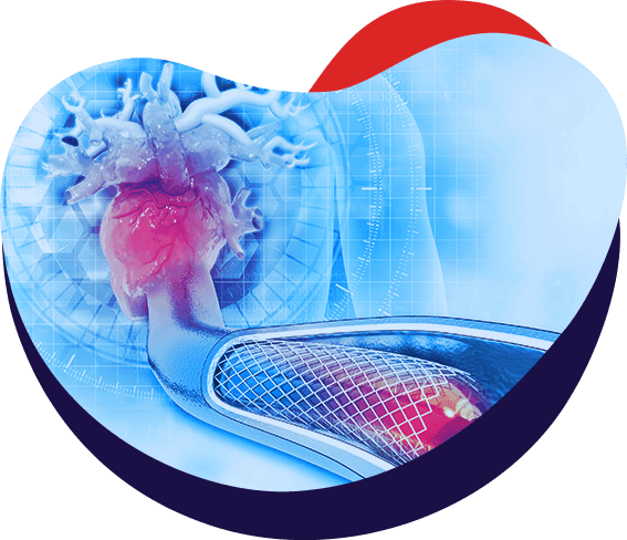 Minimally Invasive Coronary Stenting