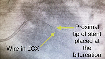 HeartCare4life, Dr. Vimal Nanavati, Board Certified in Cardiology and Interventional Cardiology LAD Lesion - Before