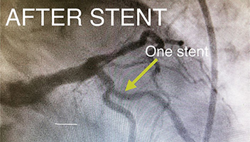HeartCare4life, Dr. Vimal Nanavati, Board Certified in Cardiology and Interventional Cardiology LAD Lesion - Before