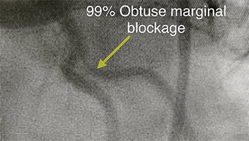 HeartCare4life, Dr. Vimal Nanavati, Board Certified in Cardiology and Interventional Cardiology LAD Lesion - Before