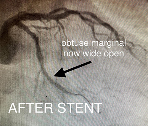 HeartCare4life, Dr. Vimal Nanavati, Board Certified in Cardiology and Interventional Cardiology Obtuse Marginal Block - After