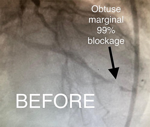 HeartCare4life, Dr. Vimal Nanavati, Board Certified in Cardiology and Interventional Cardiology Obtuse Marginal Block - Before