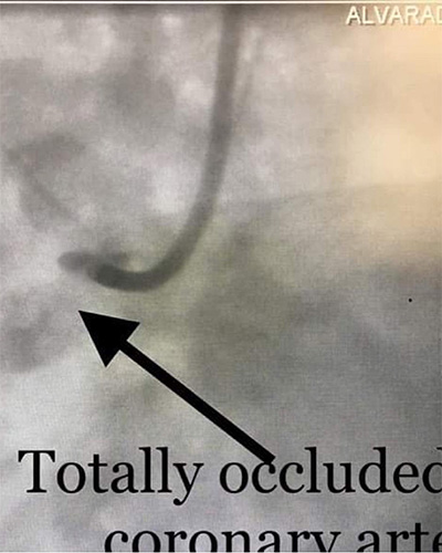 HeartCare4life, Dr. Vimal Nanavati, Board Certified in Cardiology and Interventional Occluded Artery