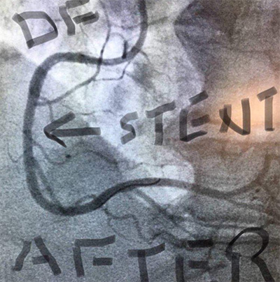 HeartCare4life, Dr. Vimal Nanavati, Board Certified in Cardiology and Interventional Cardiology DF Stent After