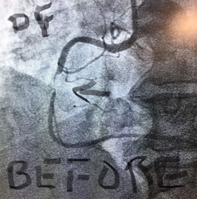 HeartCare4life, Dr. Vimal Nanavati, Board Certified in Cardiology and Interventional DF Stent Beforfe