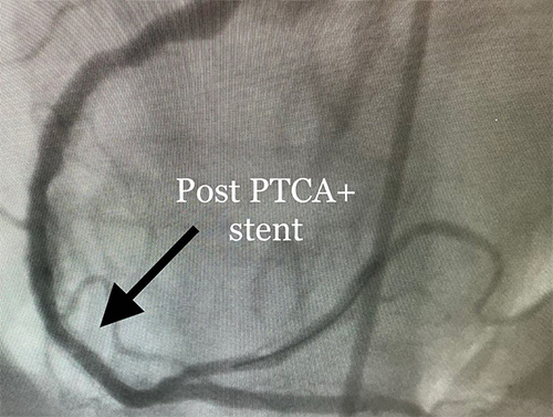 HeartCare4life, Dr. Vimal Nanavati, Board Certified in Cardiology and Interventional Cardiology Post PTCA Stent
