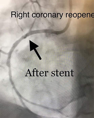 HeartCare4life, Dr. Vimal Nanavati, Board Certified in Cardiology and Interventional Cardiology Right Coronary Reopened