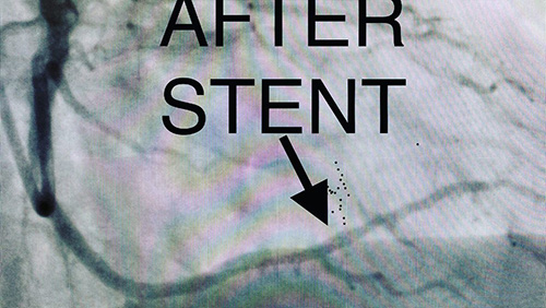 HeartCare4life, Dr. Vimal Nanavati, Board Certified in Cardiology and Interventional Cardiology Stenosis - After