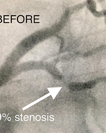 HeartCare4life, Dr. Vimal Nanavati, Board Certified in Cardiology and Interventional Before Stent