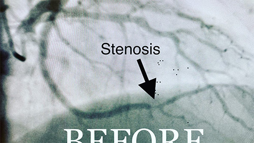 HeartCare4life, Dr. Vimal Nanavati, Board Certified in Cardiology and Interventional Cardiology Stenosis - Before
