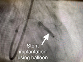 HeartCare4life, Dr. Vimal Nanavati, Board Certified in Cardiology and Interventional Cardiology Stent Implantation Balloon.jpg