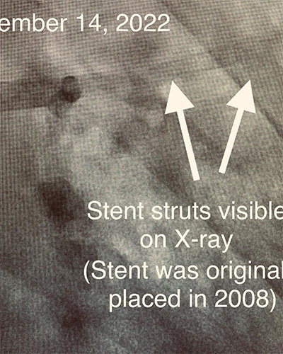 HeartCare4life, Dr. Vimal Nanavati, Board Certified in Cardiology and Interventional Stent Struts