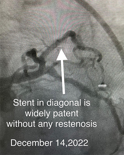 HeartCare4life, Dr. Vimal Nanavati, Board Certified in Cardiology and Interventional Cardiology Stent Without Restenosis