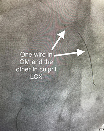 HeartCare4life, Dr. Vimal Nanavati, Board Certified in Cardiology and Interventional Cardiology Wire in LCX