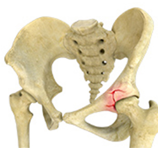 Picture of Acetabular Fracture