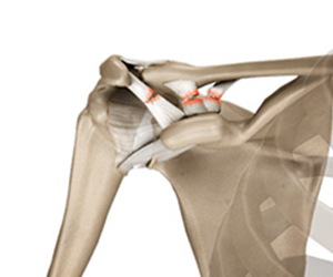 Picture of Acromioclavicular Joint Dislocation