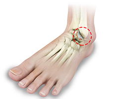 Picture of Ankle Arthritis