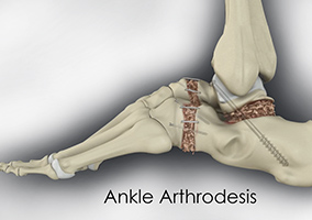 Picture of Ankle Arthrodesis