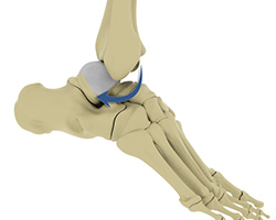 Picture of Ankle Dislocation