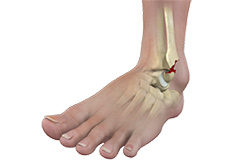 Picture of Ankle Fracture