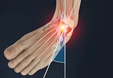 Picture of Ankle Sprain