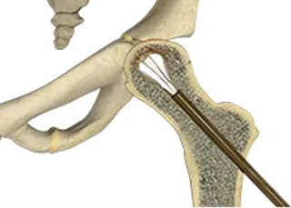 Picture of Avascular Necrosis