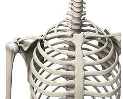 Picture of Clavicle Fracture