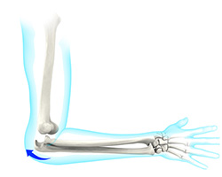 Picture of Elbow Dislocation