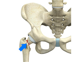 Picture of Femoral Neck Fracture