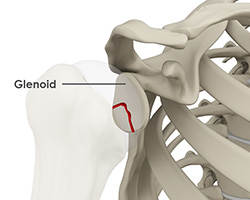 Picture of Glenoid Fracture