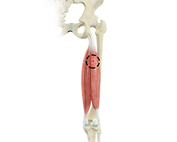 Picture of Hamstring Injuries