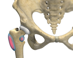 Picture of Hip Bursitis
