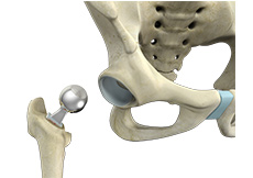 Picture of Hip Hemiarthroplasty