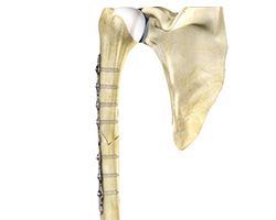 Picture of Humeral Shaft Fracture Repair