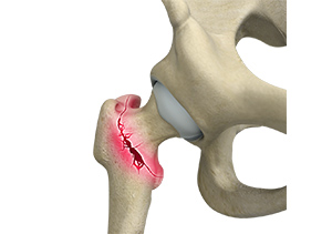 Picture of Intertrochanteric Fracture