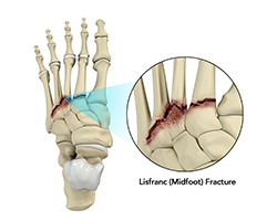 Picture of  Lisfranc Injury