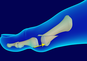 Picture of Metatarsal Fracture