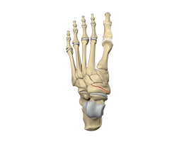 Picture of Navicular Stress Fracture