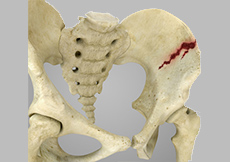 Picture of Pelvic Fractures