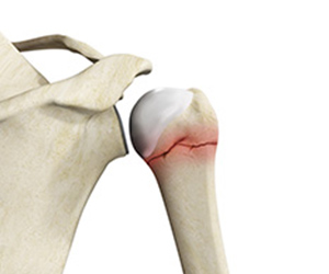 Picture of Proximal Humerus Fracture